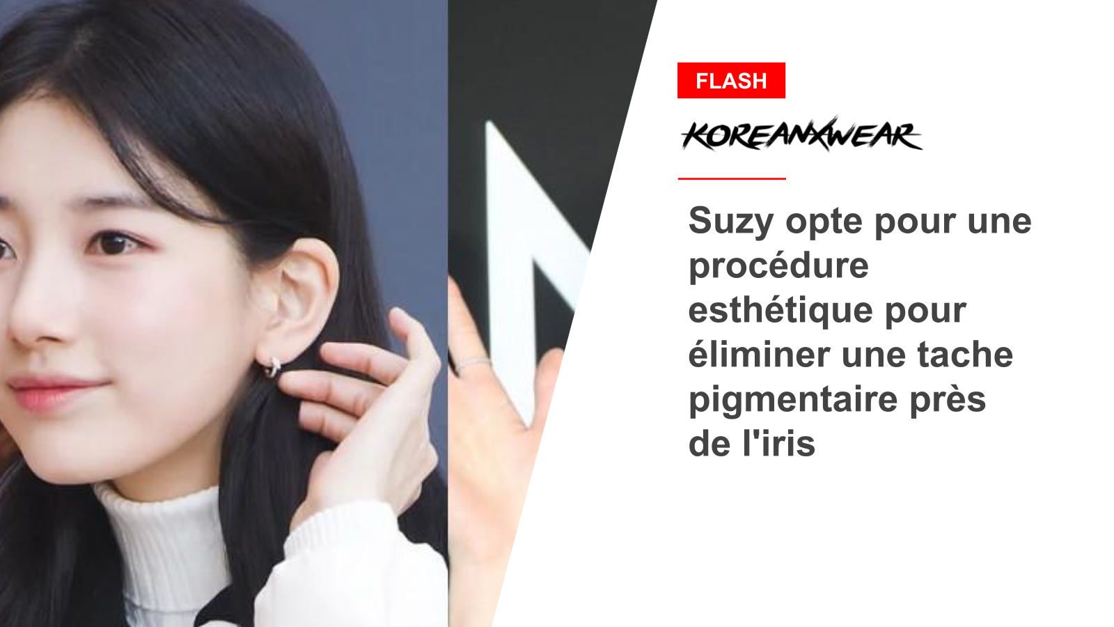 Suzy opte pour une procédure esthétique pour éliminer une tache pigmentaire près de l'iris